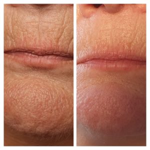 Voor en na bindweefselmassage: lippen en kin