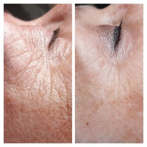 Voor en na bindweefselmassage: huid rond het oog