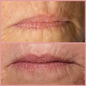 Voor en na bindweefselmassage: lippen en mondpartij