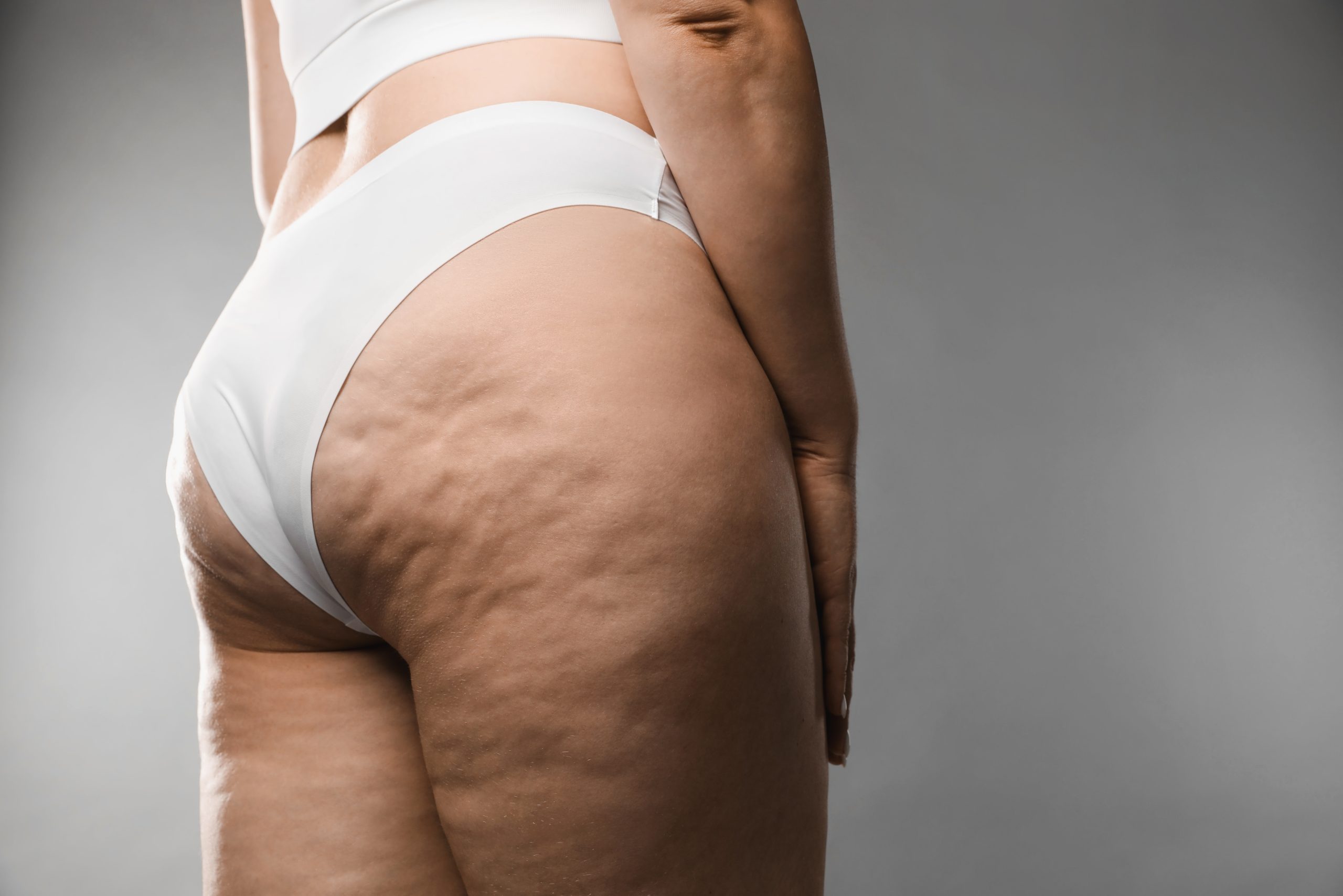 Cupping cellulite